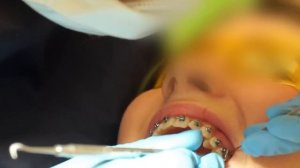 VLOG: БРЕКЕТЫ || установка брекетов, ощущения