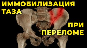 Перелом таза и тазовый пояс для иммобилизации. #ITLS #ПроСМП