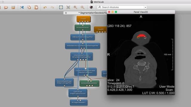 MeVisLab Geodesic ACM Level Set Image Filter Tutorial Video for Mandibular/Lower Jawbone Extraction смотреть онлайн