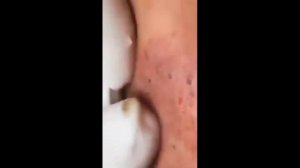 Гигантские прыщи, огромный угри/pustules, pimples, blackheads and black dots