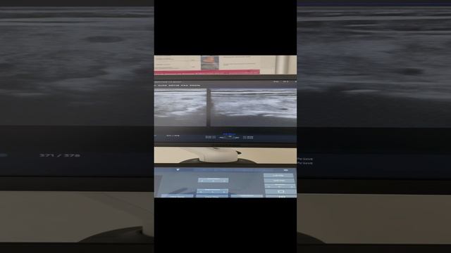 Узлы в щитовидной железе. Обследование сосудов. Узи сосудов. Флеболог. Флеболог Москва смотреть онлайн