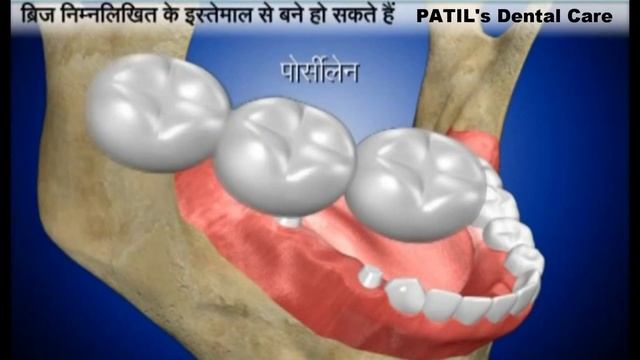 फिक्स दांत लगाना | Dental Bridge in Hindi смотреть онлайн