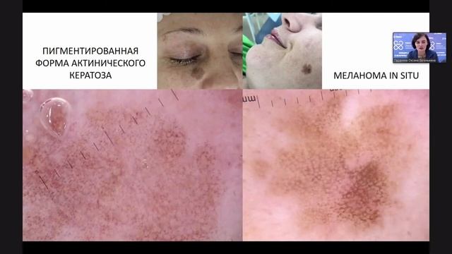 Диагностика немеланоцитарных новообразований кожи