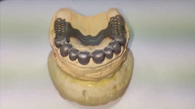 Зубные протезы с фиксацией на телескопических коронках | Зубной Техник смотреть онлайн