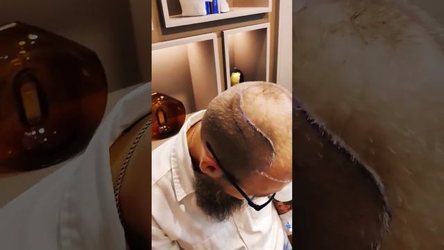 Процесс трансплантации волос в hairneva_hairtransplant istanbul turkey shorts