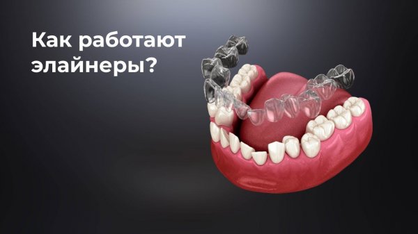 Как работают элайнеры?