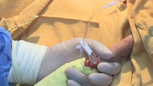 PICC Line insertion 21-22 смотреть онлайн