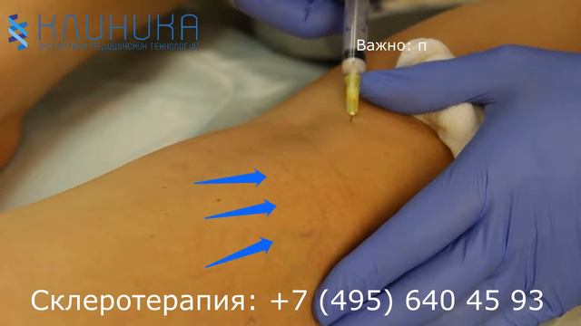 Склеротерапия полное смотреть онлайн