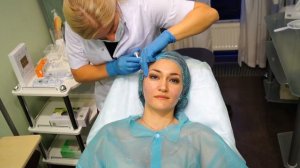 Филлеры в носогубные складки. Мой опыт и мнение.