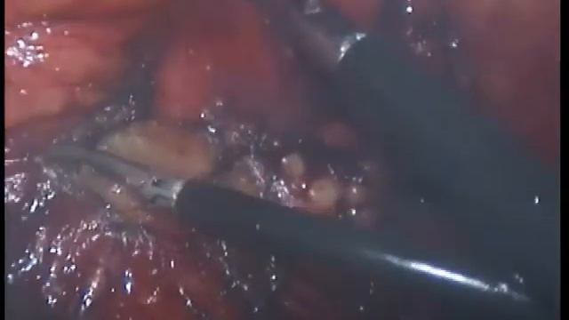 Лапароскопическое удаление почки смотреть онлайн