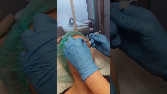 Ботокс межбровье