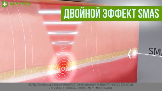 Аппарат Doublo HIFU для ультразвукового smas-лифтинга смотреть онлайн