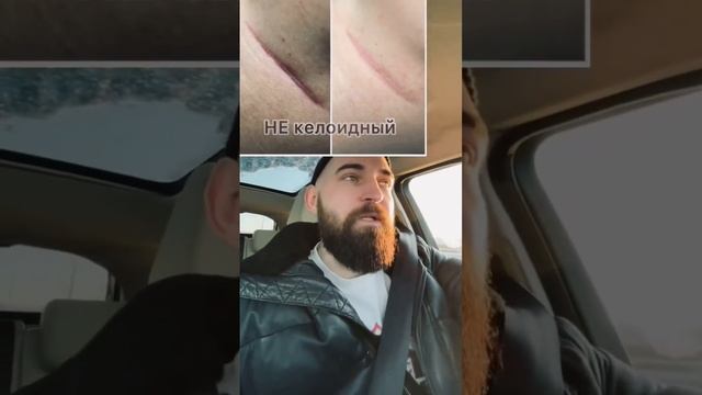 Какие шрамы нельзя перекрывать татуировкой? смотреть онлайн