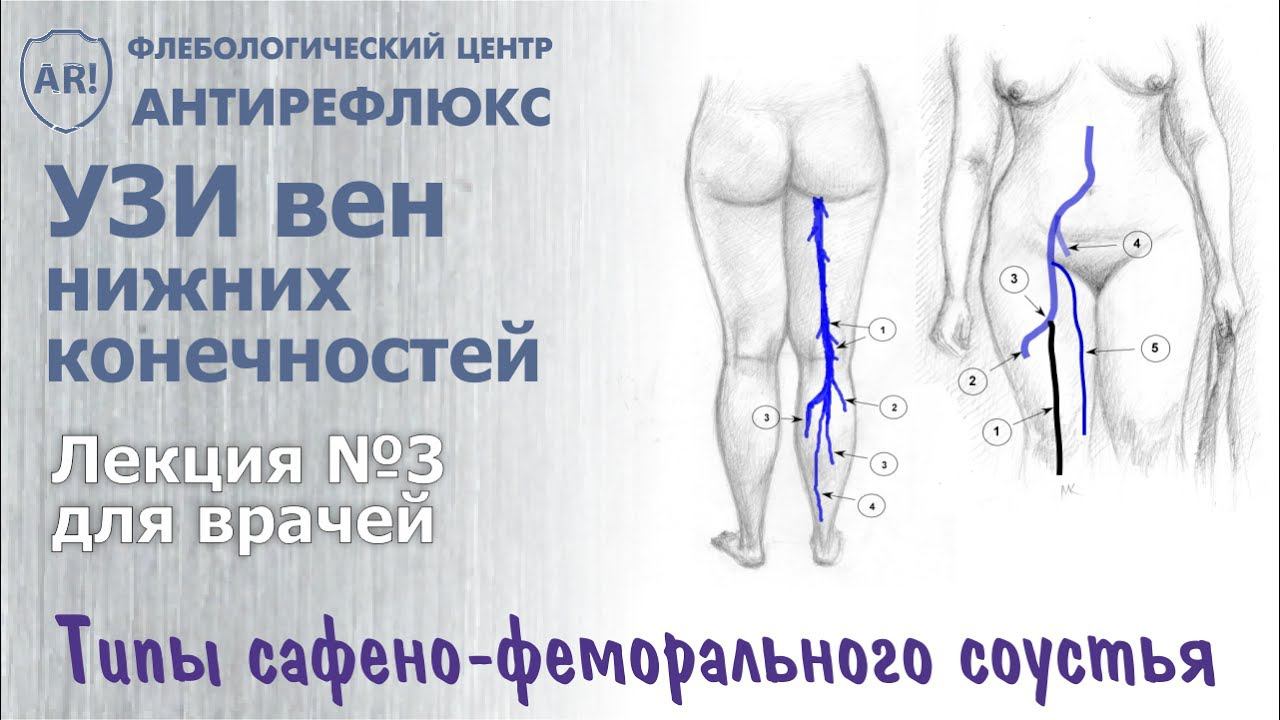УЗИ вен нижних конечностей - конфигурация СФС смотреть онлайн