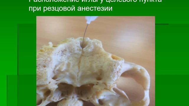 Способы местной анестезии на верхней и нижней челюсти смотреть онлайн