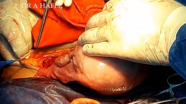 BEST CAESAREAN SECTION  TECHNIQUE