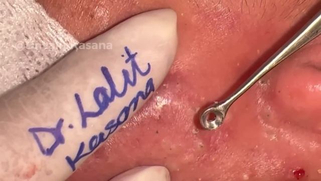 Deep Blackhead Removal By @drkasanas