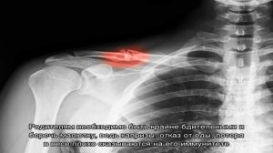 Что делать при переломах ключицы разных видов? Лечение перелома ключицы с помощью шины, корсета, г.