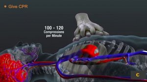 При оказании помощи пострадавшему от внезапной остановки сердца не все #АВД одинаковы