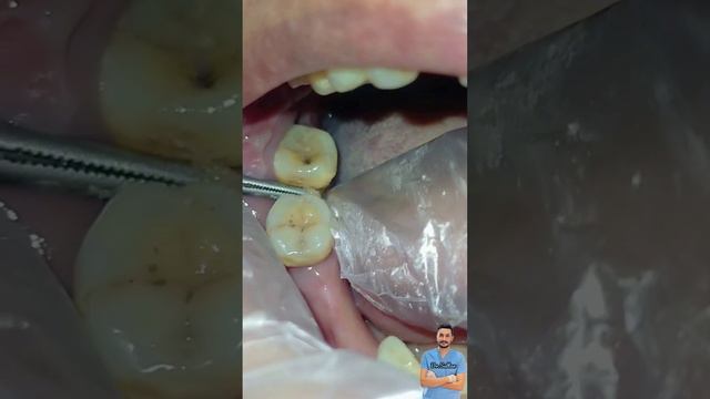 خلع سريع لضرس سفلي عائم || لخلخة الاسنانExtraction of teeth that have become loose смотреть онлайн