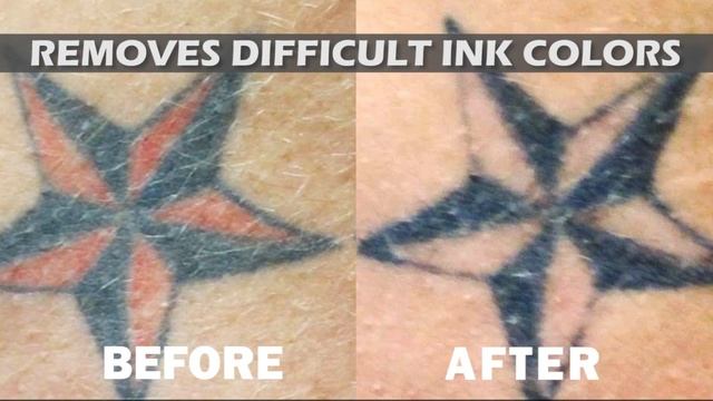 Tampa Tattoo Removal with PicoSure смотреть онлайн