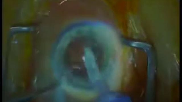 Standard Phaco Stellaris AC | Augenklinik Klinikum Ludwigshafen смотреть онлайн