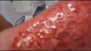 Последствия химического ожога