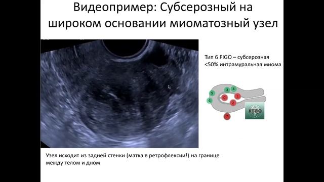 Классификация миомы матки FIGO смотреть онлайн