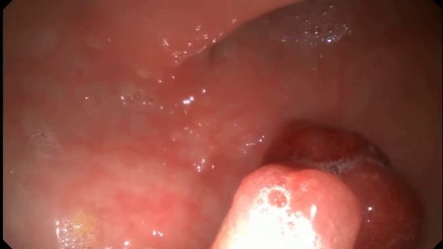 Удаление полипа толстой кишки смотреть онлайн