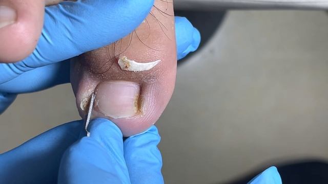 The root of the nail is inflamed and rotten, full of dirt【Pedicure Master Lin Jun】 смотреть онлайн