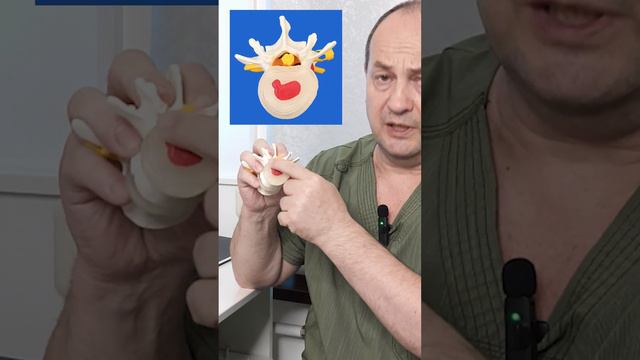 Грыжа позвоночника и протрузия. В чём разница? смотреть онлайн