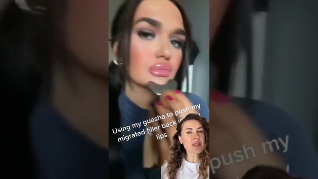 Как собрать губы после миграции геля #омоложение #уколыкрасоты #морщины #губы #ботокс #кожа #уход смотреть онлайн