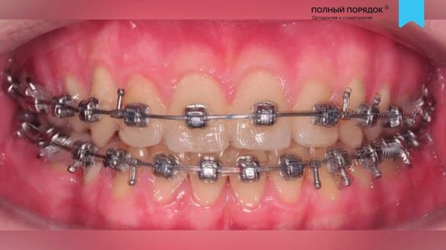 Лечение скученности с удалением — прогресс всего лишь за 15 месяцев смотреть онлайн