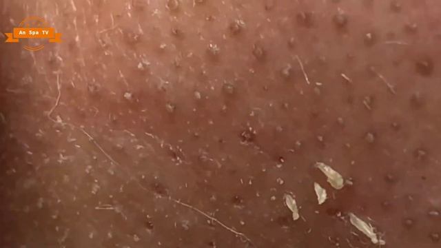 #05 Best Nose Plucking Blackheads Whiteheads Removal | Acne Treatment смотреть онлайн