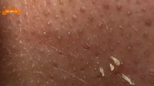 #05 Best Nose Plucking Blackheads Whiteheads Removal | Acne Treatment