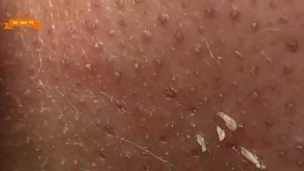 #05 Best Nose Plucking Blackheads Whiteheads Removal | Acne Treatment