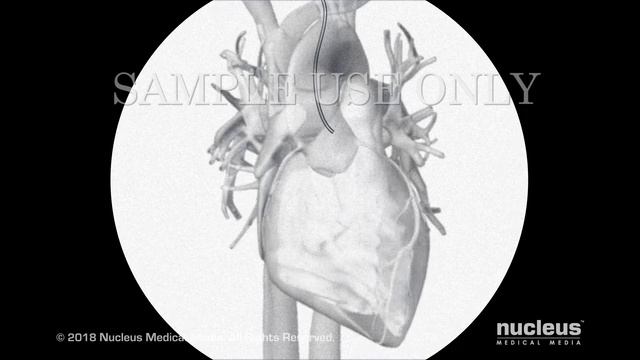 Coronary Angioplasty (Femoral Approach)