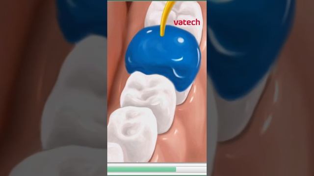 Подготовка зуба к установке светоотверждаемой пломбы? #vatech #стоматология #зубы