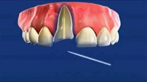 Наращивание однокорневого зуба с помощью штифта