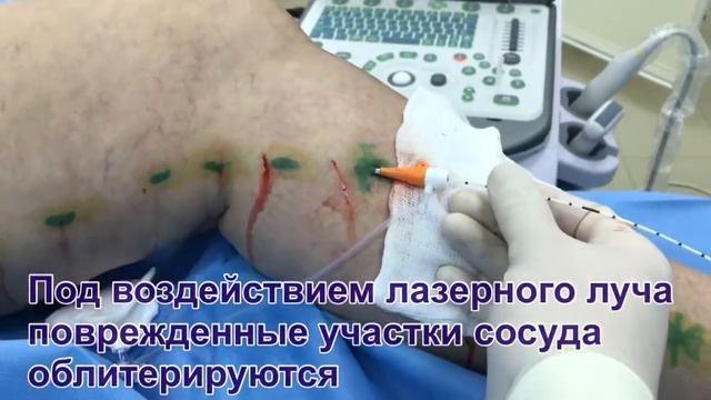 ЭВЛК. Эндовазальная лазерная коагуляция вен смотреть онлайн