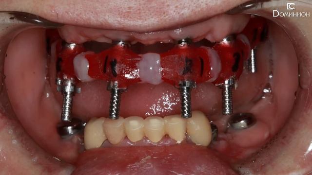 Имплантация и установка металлокерамических коронок. Левковский В.А. (Клиника Доминион) смотреть онлайн