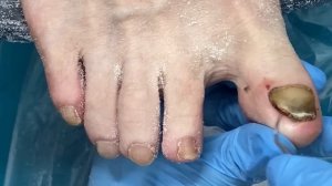 Онихогрифоз / Установка титановой нити / Зачистка ногтя / Как зачистить ноготь / Толстый ноготь