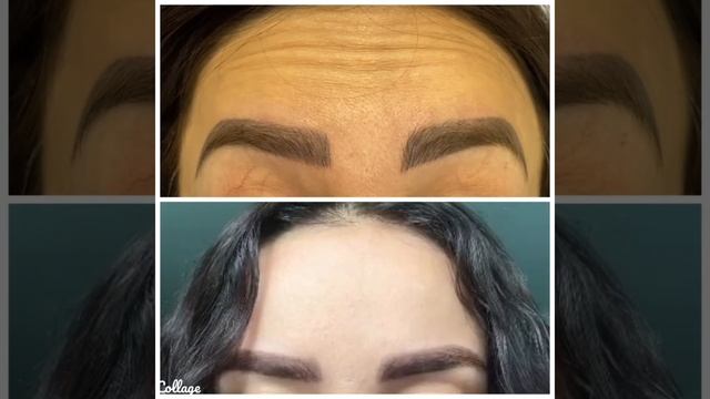 Ботулинотерапия?                          Лоб и межбровье ✅