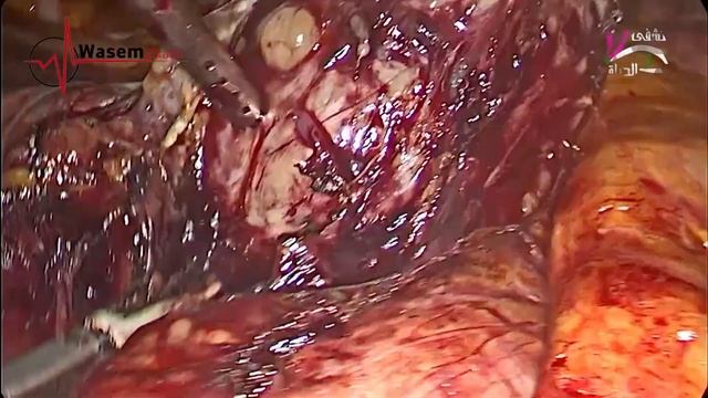Lap. Aortocaval LN Biopsy смотреть онлайн