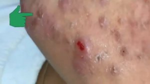 Большой прыщ. big acne.