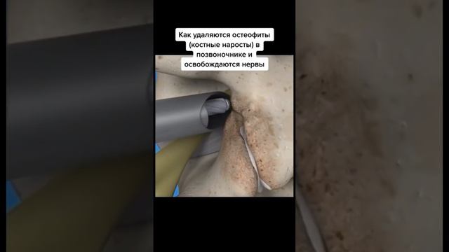 Как освободить сдавленный нерв? смотреть онлайн