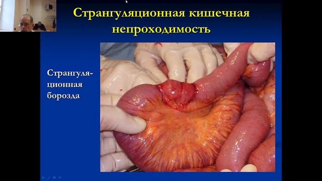 Факультетская хирургия №8 "Острая кишечная непроходимость" смотреть онлайн