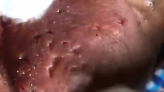 КОВЫРЯЕТ КРОВАВЫЕ ПРЫЩИ НА НОСУ И ЩЕКАХ смотреть онлайн