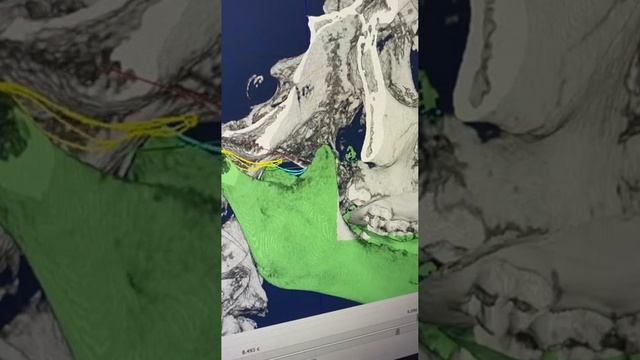 Анализ движения нижней челюсти в виртуальной 3D модели черепа смотреть онлайн