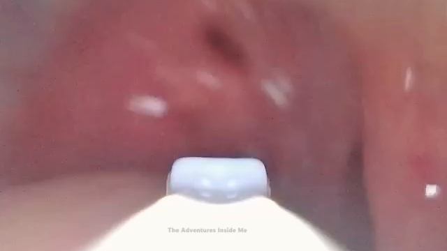 HUGE TONSIL STONES REMOVED | AIM 29 смотреть онлайн